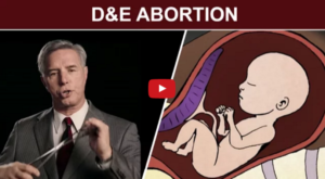 D&E Abortion