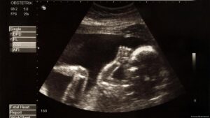 Lancaster Teen Abortion