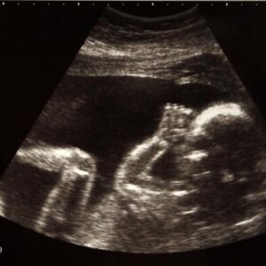 Lancaster Teen Abortion