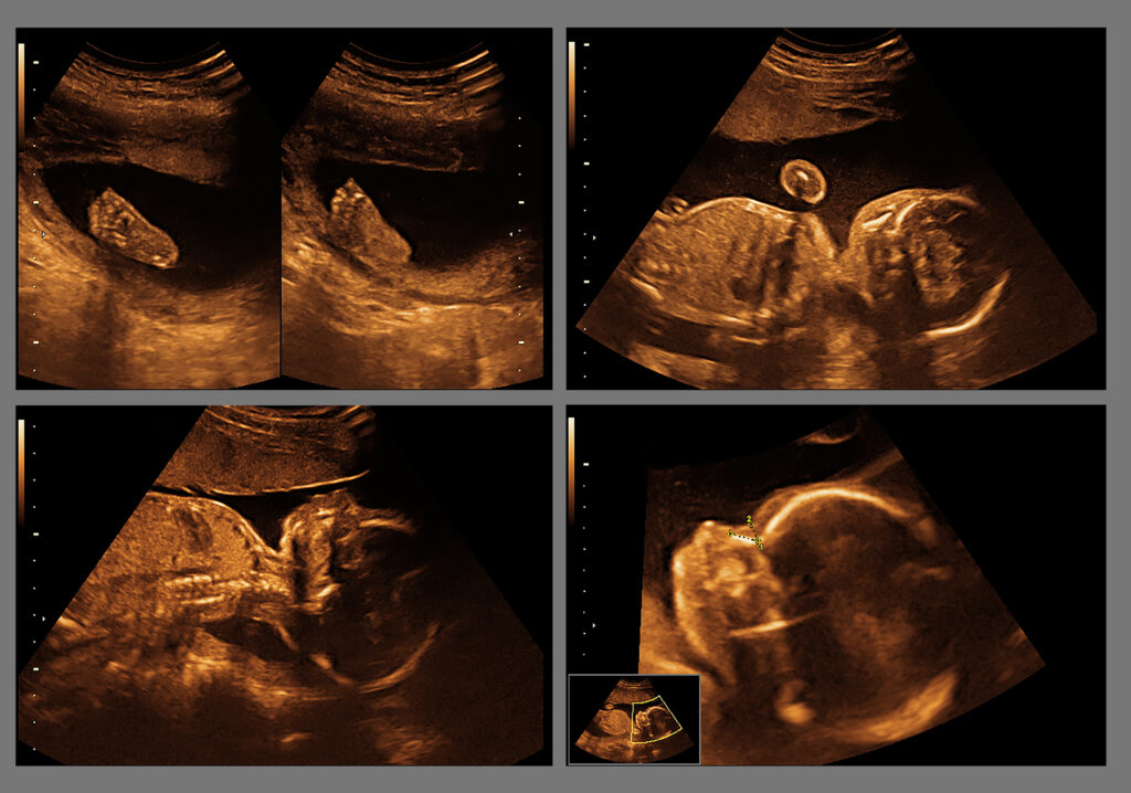 Planned Parenthood Smears Baby Development Education in Schools