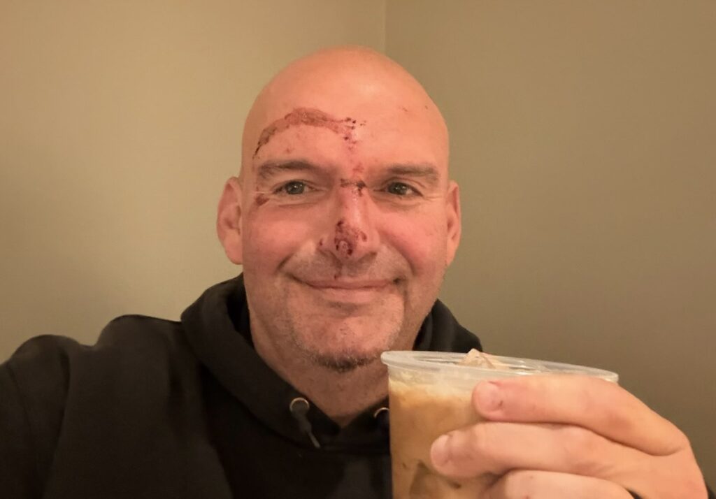 Senator John Fetterman of Pennsylvania revealed that he received 20 stitches following a fall near his home two days ago, prompted by what his office described as a flare-up stemming from a cardiac-related issue.