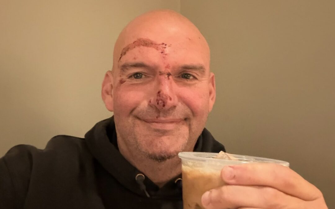 Senator John Fetterman of Pennsylvania revealed that he received 20 stitches following a fall near his home two days ago, prompted by what his office described as a flare-up stemming from a cardiac-related issue.