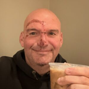 Senator John Fetterman of Pennsylvania revealed that he received 20 stitches following a fall near his home two days ago, prompted by what his office described as a flare-up stemming from a cardiac-related issue.